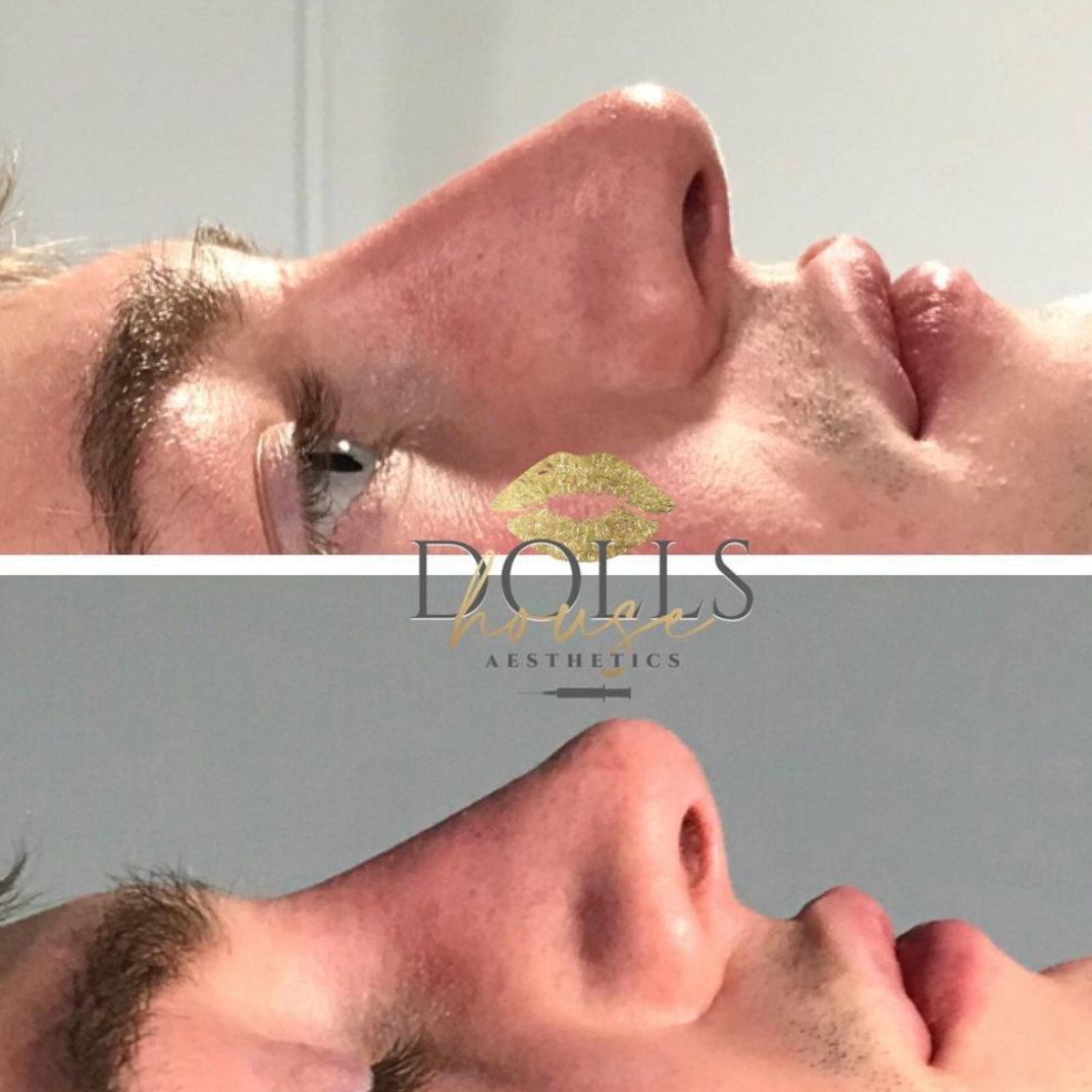 Non Surgical Nose Job