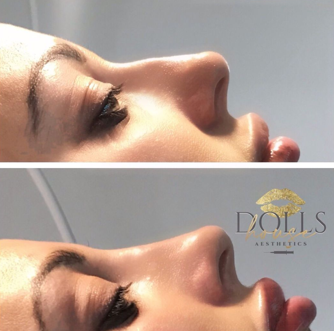 Non Surgical Nose Job